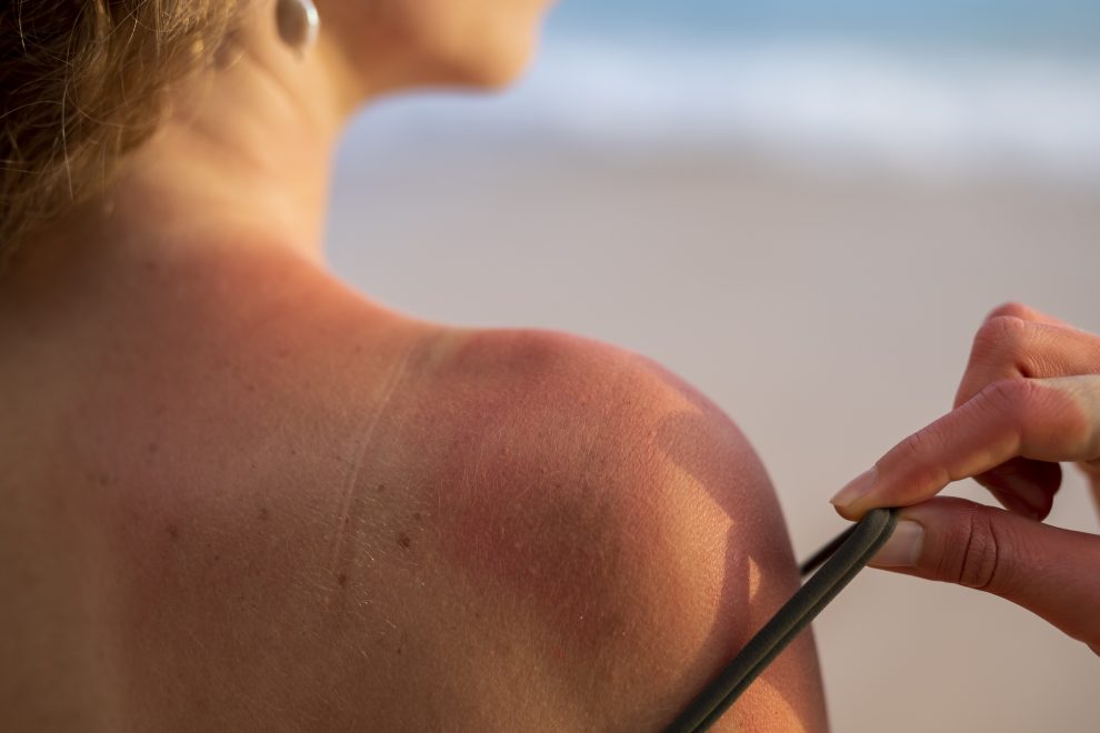 Al mediodía, entre las 12 y las 14 horas, la radiación solar tiene su mayor impacto. 